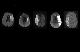 MRI scans showing brain damage in the stroke patients who took part in the pilot study