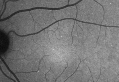 Credit: UCL - Image of retina with hyperfluorescent signals