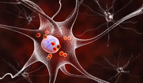 lewy body dementia